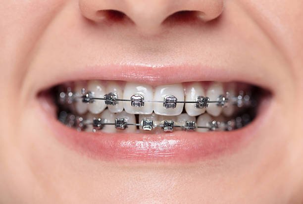 Brackets