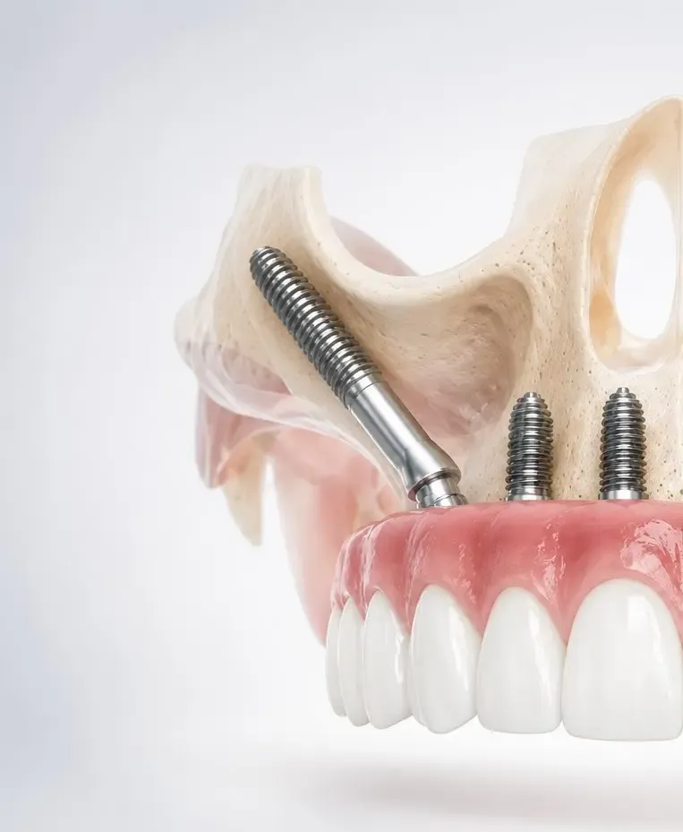 Implantes Cigomáticos